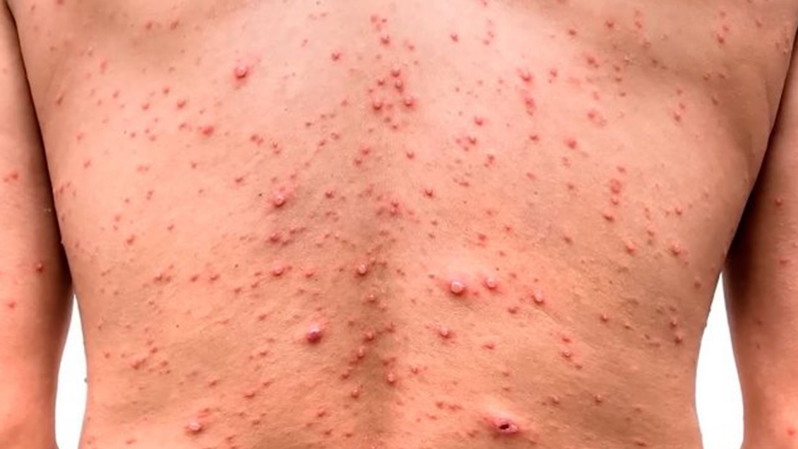 Epidemióloga recomienda reforzar el sistema sanitario para enfrentar la viruela del mono