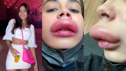 Se hizo un procedimiento estético y una reacción alérgica la hizo viral