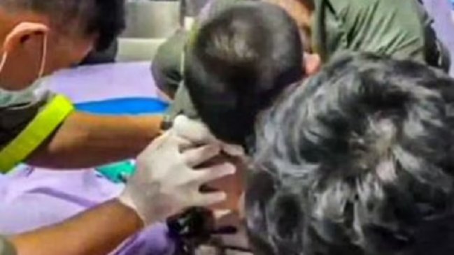 Hombre tuvo un anillo de metal atascado en el pene por cuatro meses