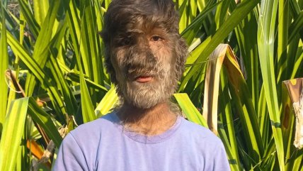   Joven que ha recibido bullying toda su vida por extraña condición: 