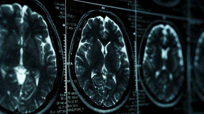  Nuevo ensayo confirma la eficacia de fármaco experimental contra el alzhéimer  