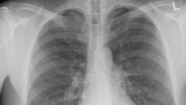 Mujer se fracturó cuatro costillas tras sufrir un ataque de tos