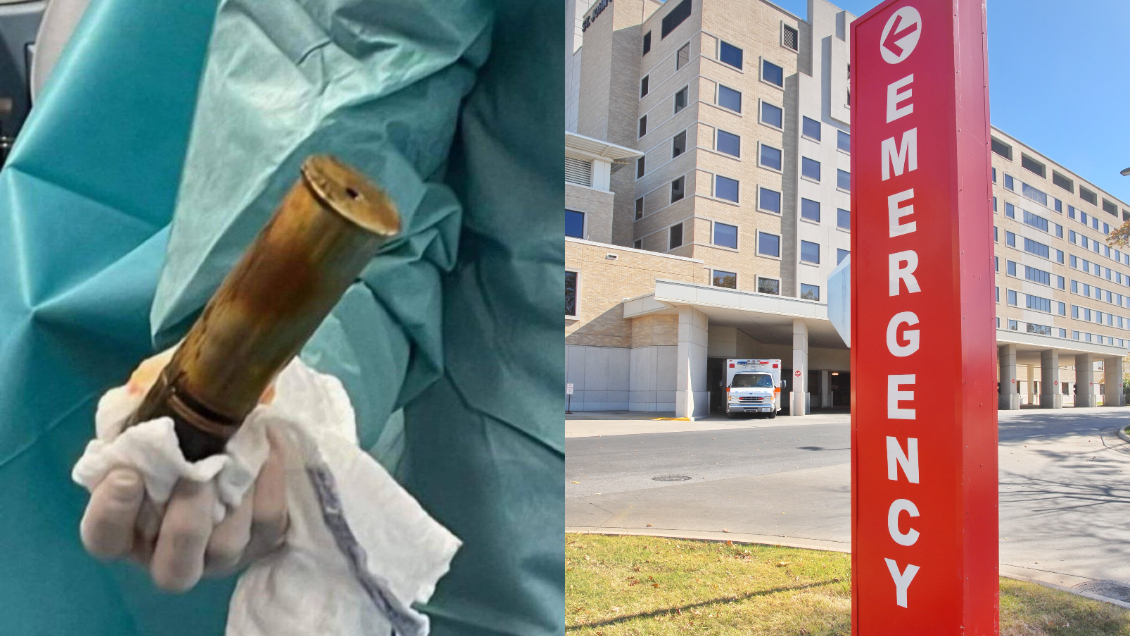 Hombre con bomba de la Primera Guerra Mundial atascada en su ano obligó a evacuar hospital