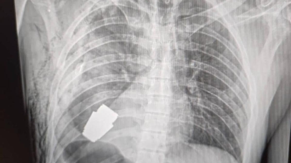 Médicos extrajeron una granada sin explotar del pecho de un soldado ucraniano