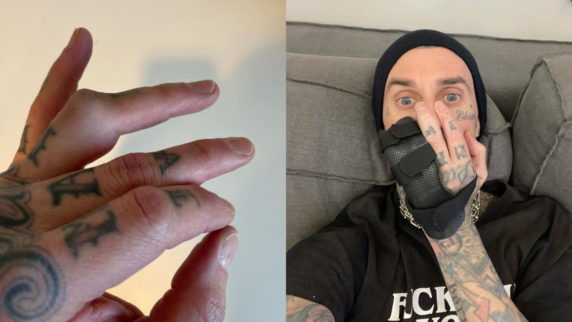 ¿Llegará a Lollapalooza?: Travis Barker de Blink-182 se someterá a cirugía en su dedo