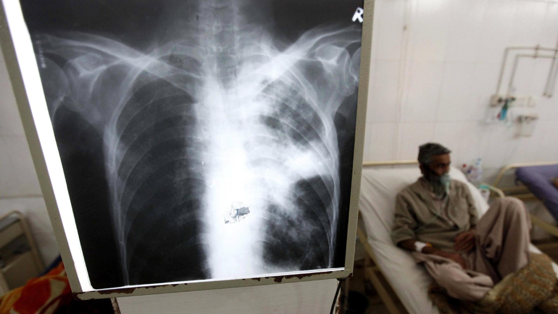 Expertos reclaman dar un paso adelante para erradicar la tuberculosis