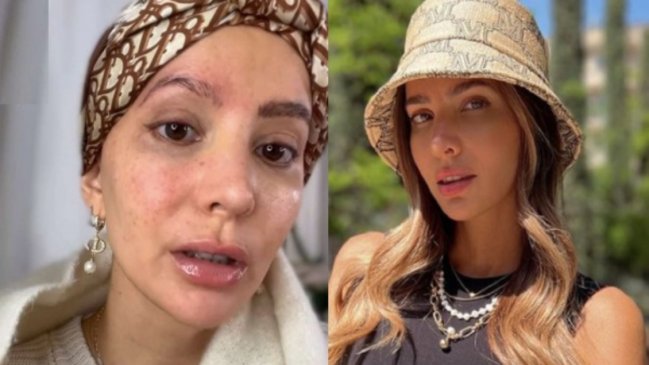 Aylén Milla detalla evolución de su cáncer y adelanta el próximo procedimiento quirúrgico que enfrentará