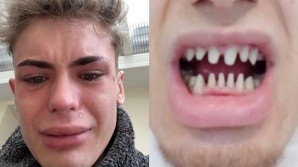Modelo se puso carillas y se le infectó la sonrisa: 