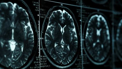  EE.UU. aprobó el uso de un medicamento que ralentiza los síntomas del alzheimer  