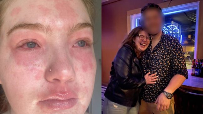 Joven asegura ser alérgica a su pololo y divide a redes: 