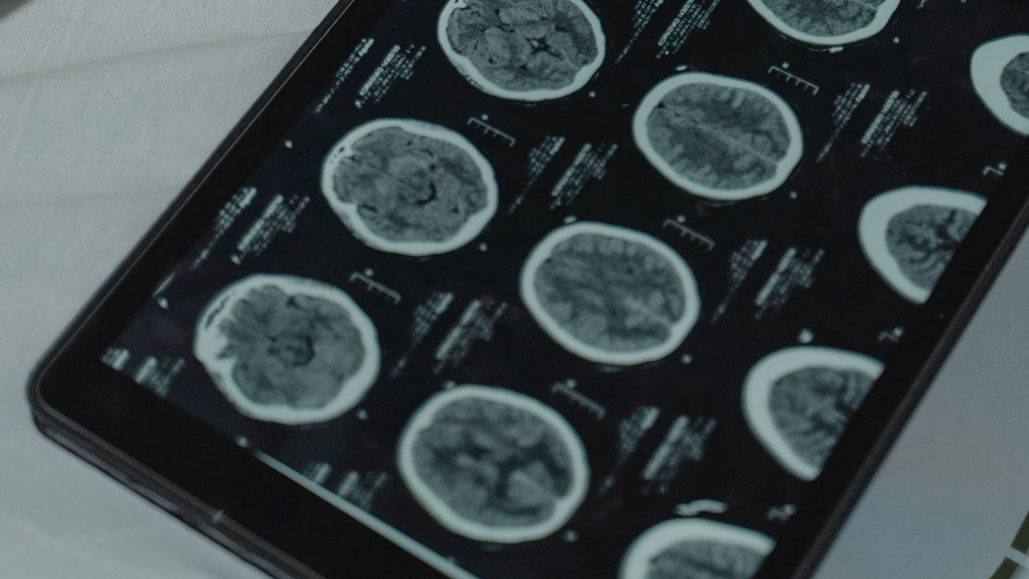 Un ensayo clínico logra reducir el tamaño de un raro tumor cerebral en un 91 por ciento