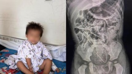   Niño de dos años sobrevive luego de tragarse ocho agujas 