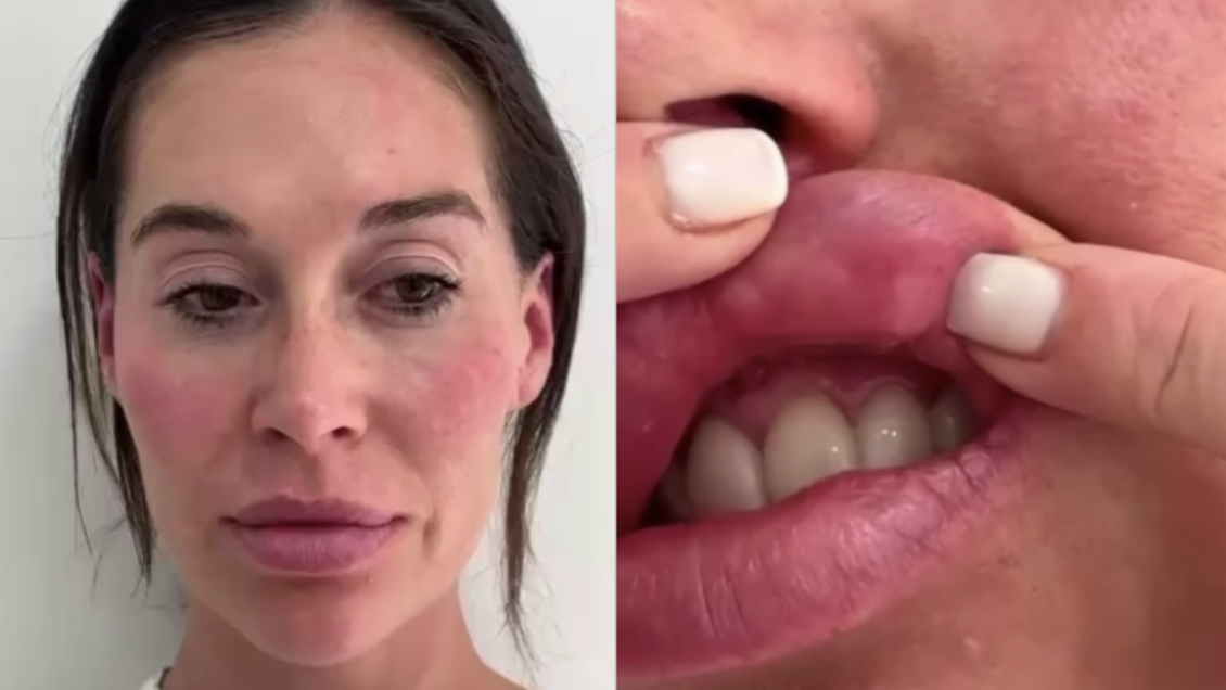 Vale Roth muestra las consecuencias de procedimiento estético mal hecho: 