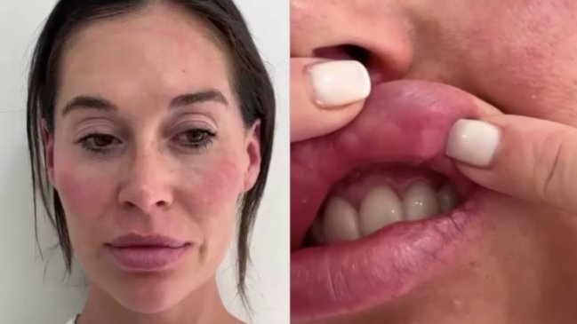 Vale Roth muestra las consecuencias de procedimiento estético mal hecho: 