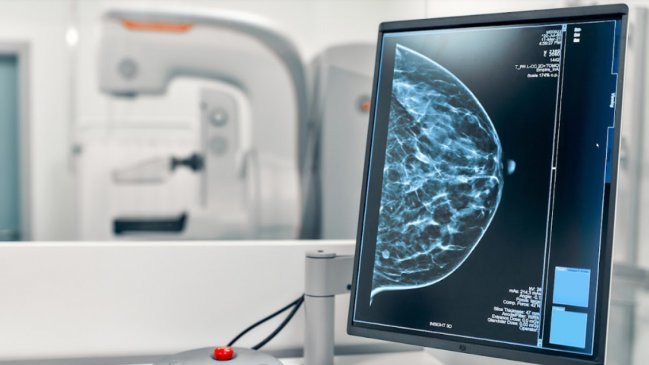  OMS: El cáncer de mama es la segunda causa de muerte de mujeres en Chile  