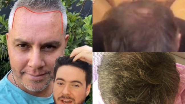 ¿Cirugía de trasplante capilar? José Miguel Viñuela confesó qué se hizo en el pelo