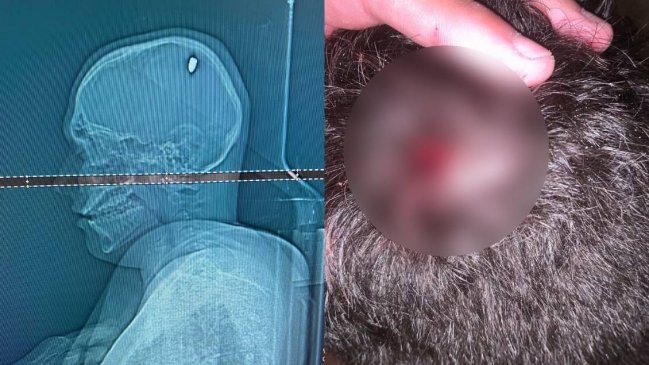 Pensó que lo golpearon con una piedra en la cabeza, y en realidad fue alcanzado por una bala