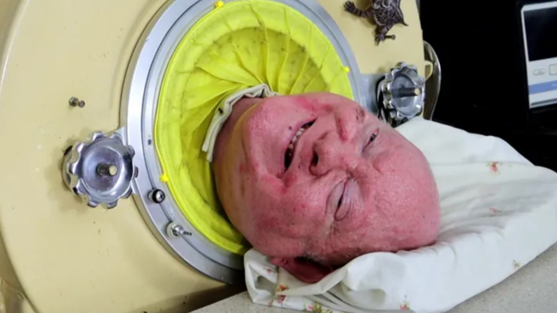 Murió Paul Alexander, el hombre que vivió 70 años en un 