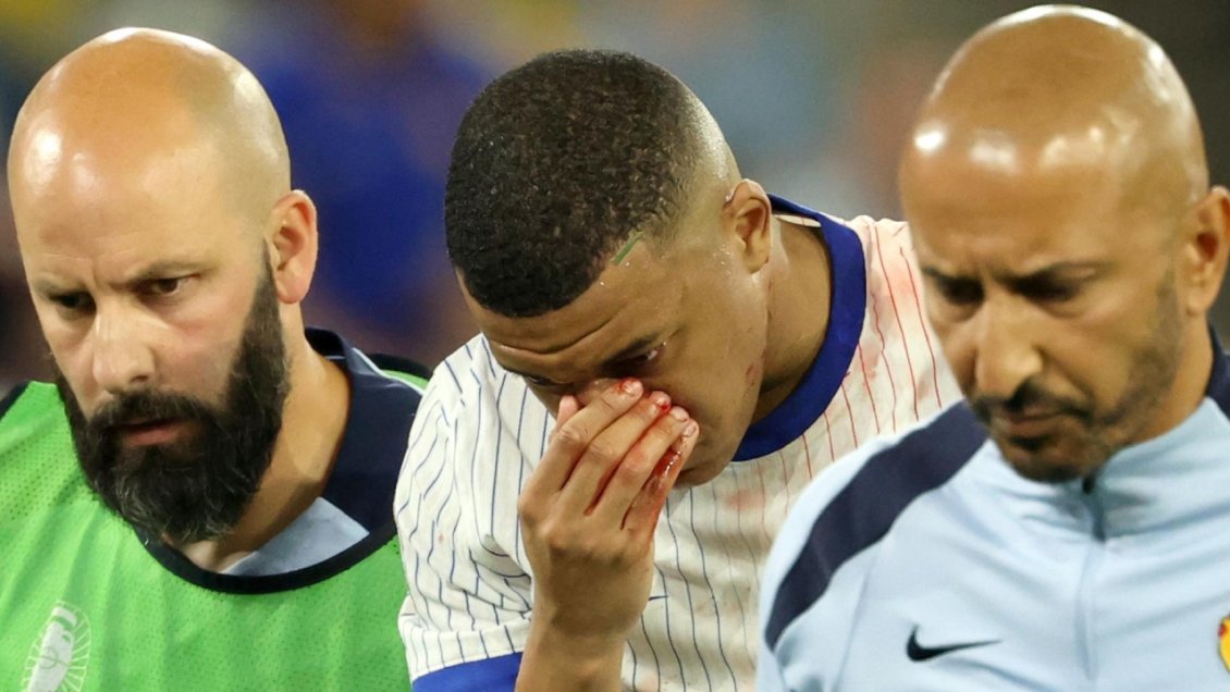 Mbappé sufrió fractura de nariz y será operado en hospital de Dusseldorf