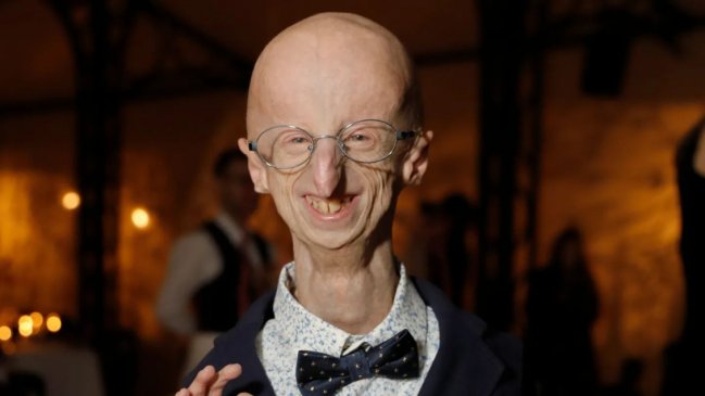 ¿Qué es la progeria, la enfermedad que padecía Sammy Basso?
