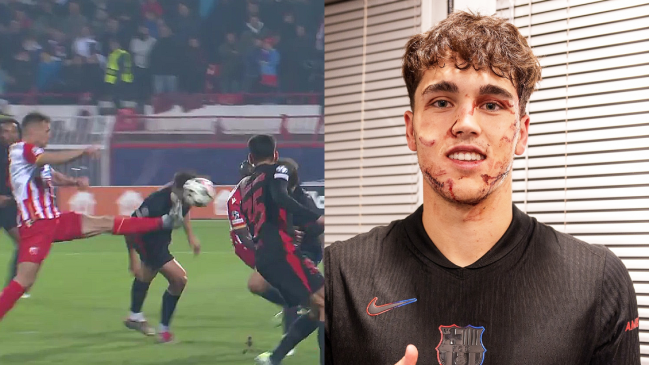 Pau Cubarsí necesitó 10 puntos de sutura en el rostro tras fuerte patada en triunfo de Barcelona