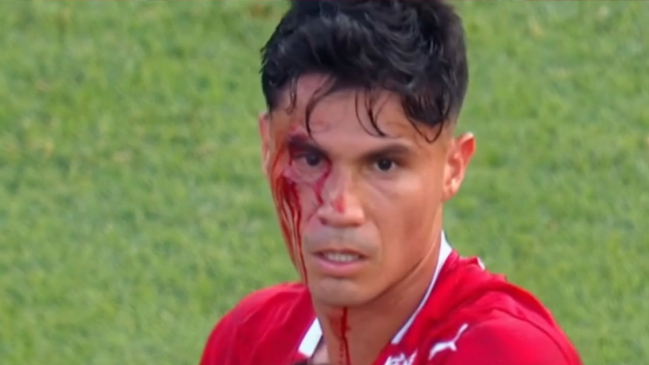 Pablo Galdames quedó con la cara ensangrentada en el clásico de Avellaneda