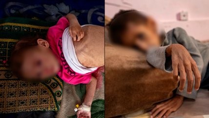   El rostro más silencioso de la guerra: desnutrición infantil en Gaza 