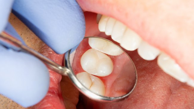 Paciente perdió nueve dientes tras tratamiento negligente en Punta Arenas