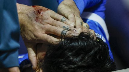   El triunfo de la UC ante Limache quedó marcado por la dura lesión que sufrió Zampedri 