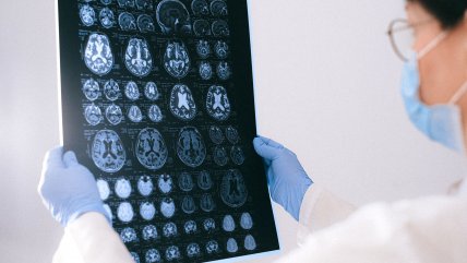 ¿Cómo saber si me está dando un accidente cerebrovascular (ACV)?
